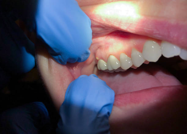Best Dentist for Tooth Abscess  in Christmas, FL